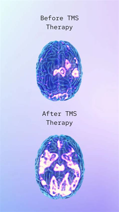 Effective Tms Therapy For Mental Health Disorders Bespoke Treatment