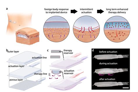 Design prevents buildup of scar tissue around medical implants | MIT News | Massachusetts ...