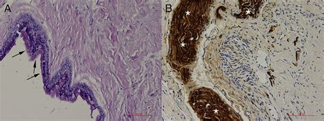 Figure 4 From Expansive Nasopalatine Duct Cysts With Nasal Involvement