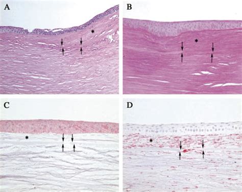 neuropathology blog: Salzmann nodular degeneration of the cornea