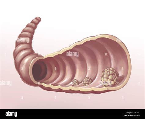 Illustration Of Polyps In The Intestines A Polyp Is An Abnormal Growth