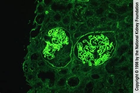 Rapidly Progressive Glomerulonephritis Rpgn Genitourinary Disorders