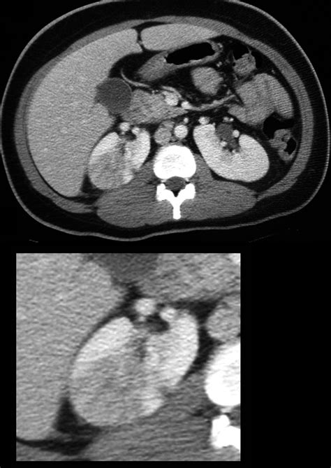 Faces Of Perfusion Abnormalities Kidney