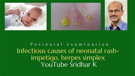 Infectious Rash In Babies Impetigo Bullous Impetigo Herpes Simplex