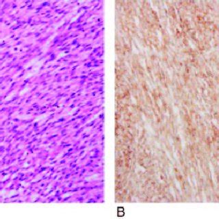 Pathologic Findings Of Leiomyosarcoma A Histopathologic Examination