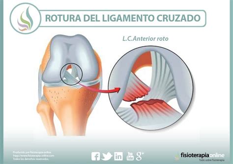 Rotura del ligamento cruzado de la rodilla información consejos y un