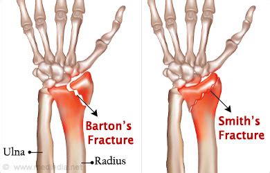 Distal Radius Fracture - Types, Symptoms, Treatment, Exercises ...