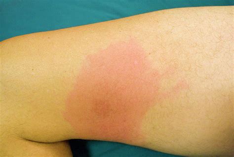 Erythema Migrans Rash Photograph By Science Photo Library Fine Art America