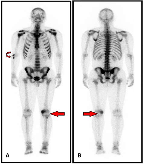 Whole Body Bone Scan With Technetium 99m HDP Prior To Left Knee