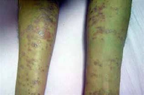 Bright Erythematous Polygonal Papules Commonly 05 25 Cm In
