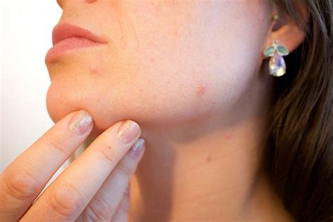 How To Get Rid Of Painful Pimples 5 Ways Ezealy Medium