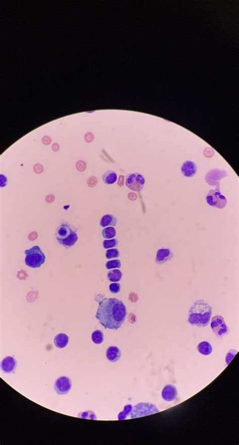 Cells Lined Up In A Peritoneal Fluid R Medlabprofessionals