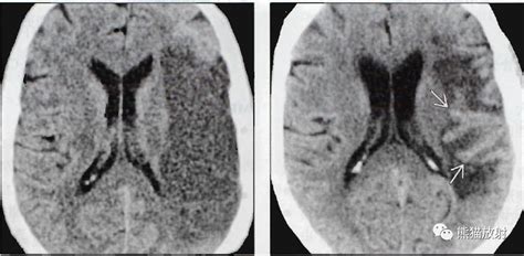 急性亚急性慢性脑梗死丨影像诊断要点 Medscicn