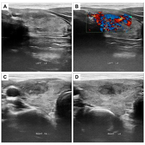 Bedside Thyroid Ultrasound Scan Showing An Enlarged Thyroid With