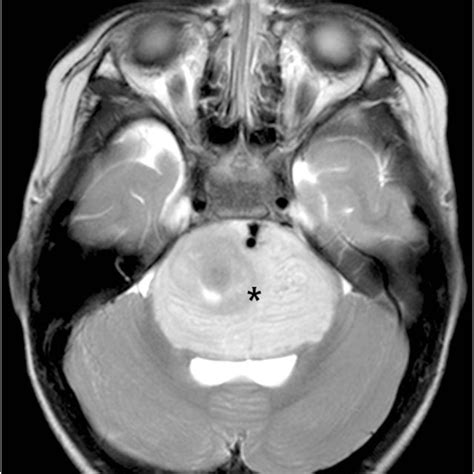 Visual symptoms associated with cranial nerve palsies. Most common ...