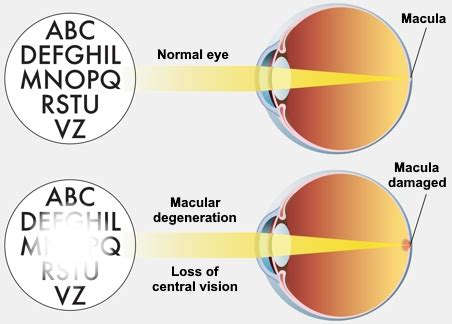 Eye Exercises For Wet Macular Degeneration - Infoupdate.org