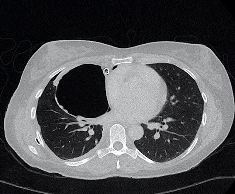 Large Air Filled Intrapulmonary Bronchogenic Cyst Associated With