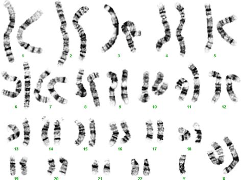 A Karyotype Of 47xxy Download Scientific Diagram