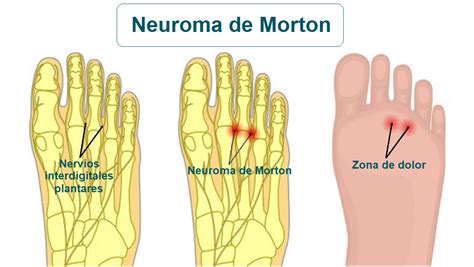 Neuroma de Morton Qué es causas síntomas tratamiento y consejos