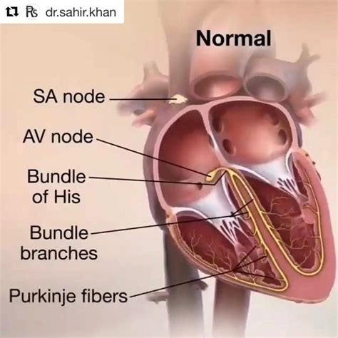 Atrial Flutter Artofit