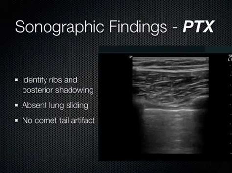 Lung Ultrasound EFFUSION CONSOLIDATION YouTube