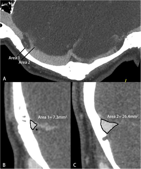 Transverse Sinus Stenosis