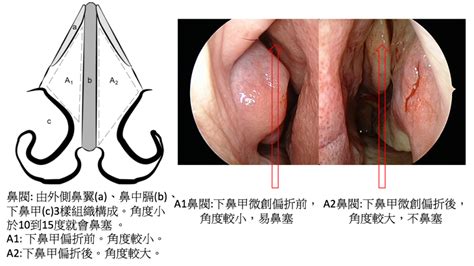 微創旋轉刀合併內視鏡下鼻甲偏折手術 中山醫訊