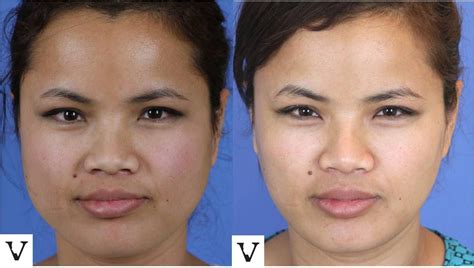 Non Surgical Jaw Reduction With Dysport Or Botox Patient Is Four