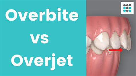 OVERBITE VS OVERJET L Dr Melissa Bailey Orthodontist YouTube