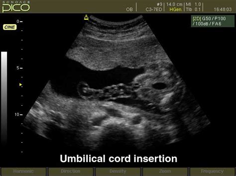 Umbilical Cord Insertion B Mode Echogramm №256