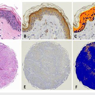 Cornulin Expression In Normal Epidermis Versus Cutaneous Squamous Cell