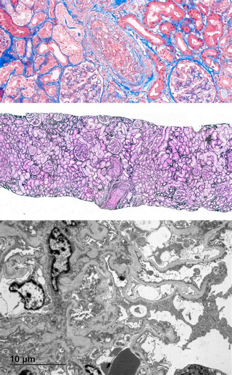 Biopsy At Diagnosis Light Microscopy Showed Overall Well Preserved