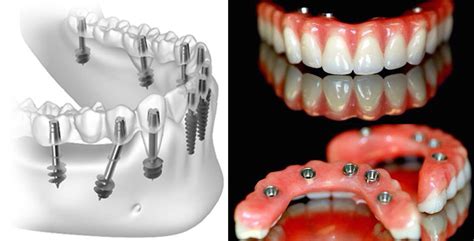 What Is Basal Dental Implant Senthil Dental Clinic