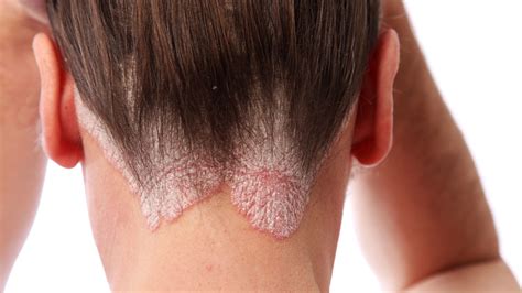 Qué Es La Psoriasis Y Por Qué Puede Causar Problemas En El Corazón
