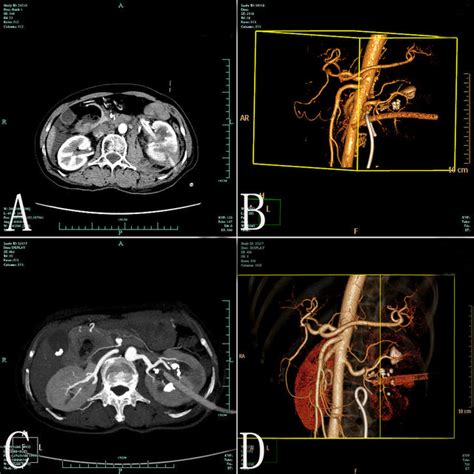 Axial Contrast Enhanced Ct And Volume Rendering Image Of Ct