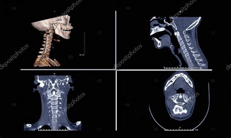 Comparación de la imagen de TC de columna C o columna cervical 3D