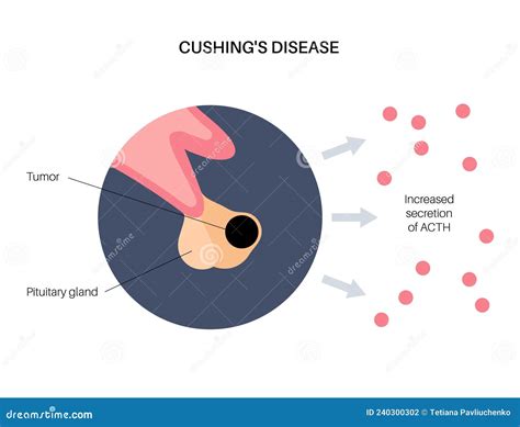 Cushing Syndrome Symptoms Illustration Of The Common Features Of The