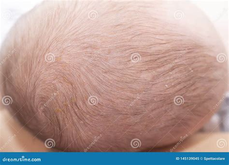 Newborn Head With Cradle Cap Stock Image Image Of Hair Infant 145139045