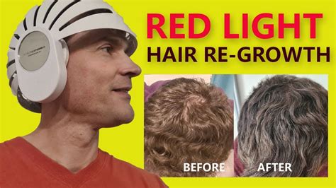 Led Red Light Hair Regrowth Review Discount Code Youtube