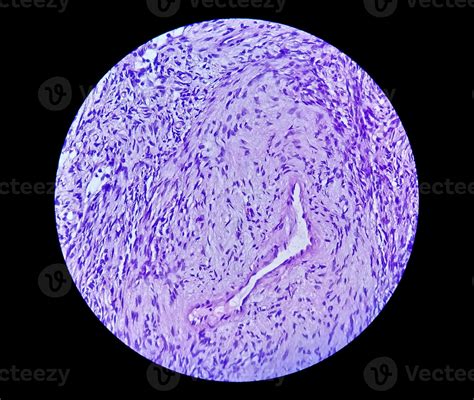 Photomicrograph of a schwannoma, a benign soft tissue tumor of ...