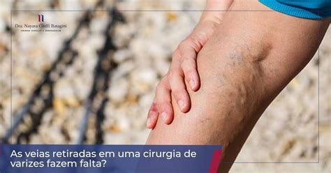 As Veias Retiradas Em Uma Cirurgia De Varizes Fazem Falta