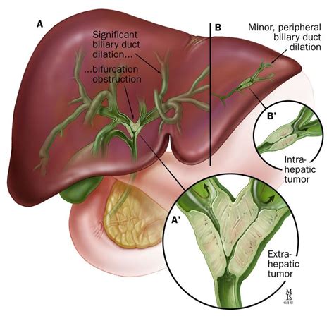 Most Common Types Of Cancer Check Here Bile Duct Cancer Awareness