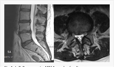 Figure 5 From The Surgical Treatment Of Single Level Multi Focal