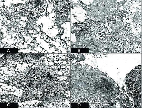 Amoebic Trophozoites Arrows Invading A The Mesenteric Fat And B