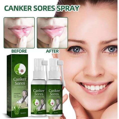 2pcs Oral Ulcer Relief Spray Professional Safe Canker Sore Spray，rapid Absorption For Oral Care