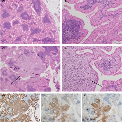 A B Histological Features Of The Warthin Tumor Hande 20× And 100×
