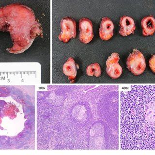 Gross And Histologic Evaluation Of The Resected Specimen A The