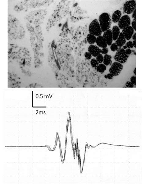 Type Sma Compare The Evidence Of Major Reinnervation In Sma With