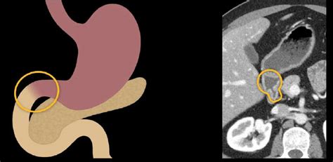 Abdominal Ct Small Intestine • Litfl • Radiology Library