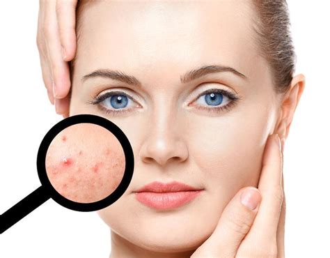 Whats The Difference Between Adult And Teenage Acne Hk Dermatology